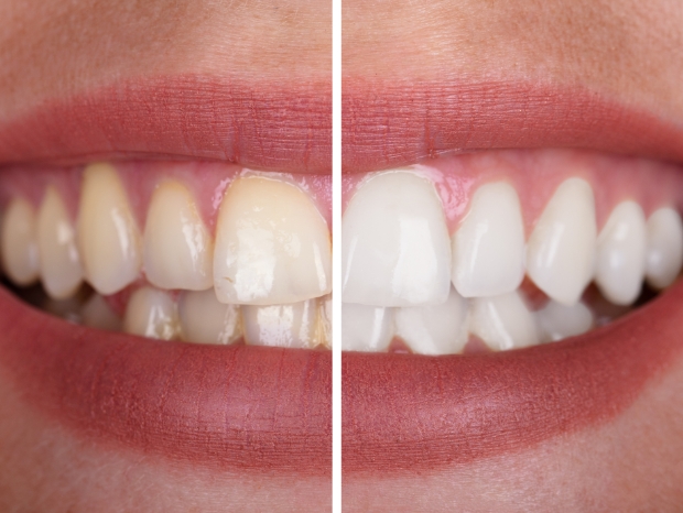 Porównanie poziomu bieli zębów